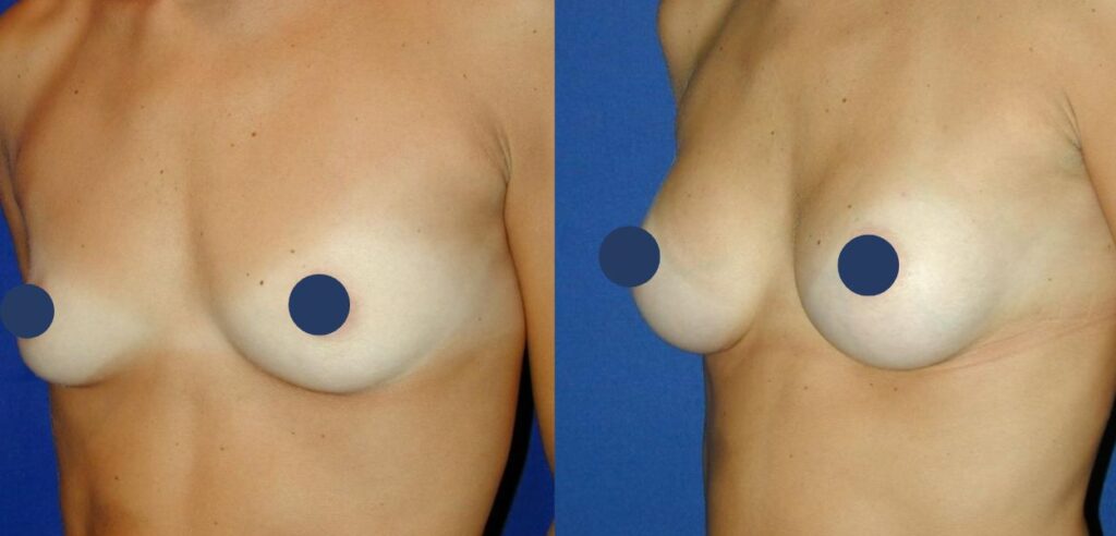 dr-even-busto-aumento